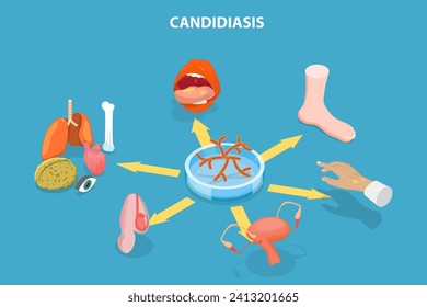 3D Isometric Flat Vector Illustration of Candidiasis, Medical Infographics