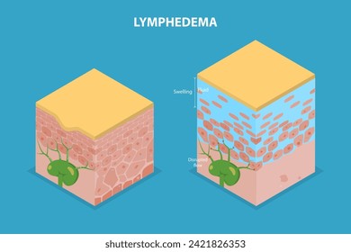 Iluminación del linfedema, trastorno del sistema linfático