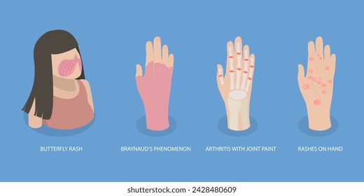 3D Isometric Flat Vector Illustration of Systemic Lupus Erythematosus, Butterfly Rash Red Patches