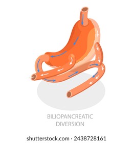 3D Isometric Flat Vector Illustration of Types Of Bariatric Surgery, Sleeve Gastrectomy. Item 1