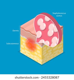 3D Isometric Flat Vector Illustration of Cellulitis, Bacterial Infection