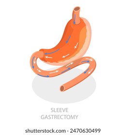 3D Isometric Flat Vector Illustration of Types Of Bariatric Surgery, Sleeve Gastrectomy. Item 5