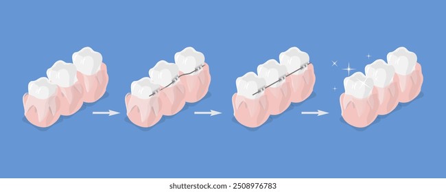 3D Isometric Flat Vector Illustration of Dental Teeth Braces, Orthodontic Care