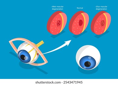 Ilustração de vetor plano isométrica 3D da degeneração macular relacionada à idade, doença ocular, problema da visão