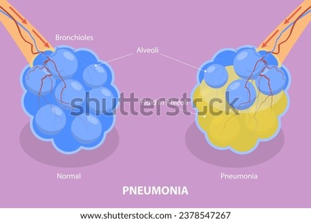 3D Isometric Flat Vector Illustration of Pneumonia