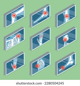 3D Isometric Flat Vector Set of Images of Human Joints , Arthritis and Osteoporosis