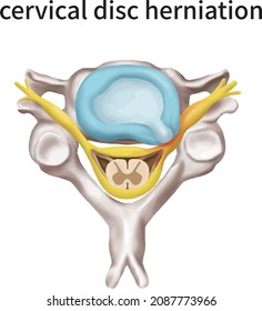 
3d medical illustration explaining cervical disc herniation