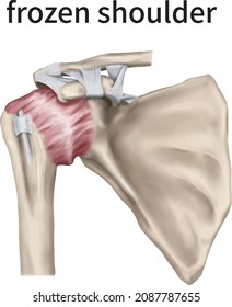 3d medical illustration explaining the frozen shoulder