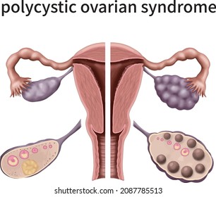 3.ª ilustración médica que explica el síndrome del ovario poliquístico