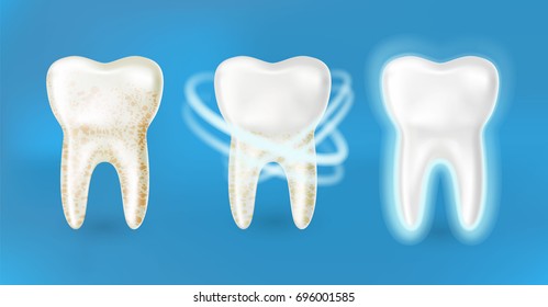 3d realistic clean and dirty tooth set on blue background, Teeth cleaning and whitening procedure. Dental health concept. Healthy enamel. Vector illustration.