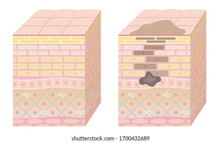 3D skin cross section. Nice skin and age spots.  Pale colored illustration.