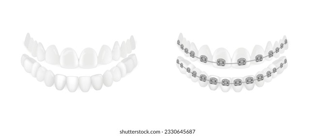 3D Teeth With And Without Orthodontic Braces. EPS10 Vector