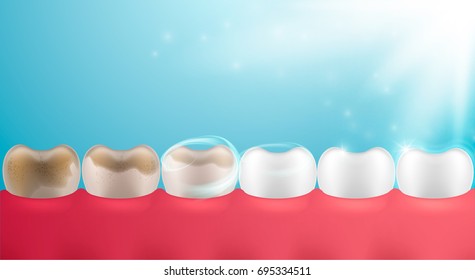 3d Tooth set, whitening design, realistic dental illustration. Teeth collection, vector template for dent surgery, clean, care, stomatology,...  Clean and dirty tooth, clearing process.