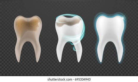 3d Tooth set, whitening design, realistic dental illustration. Teeth collection, vector template for dent surgery, clean, care, stomatology,...  Clean and dirty tooth, clearing process.