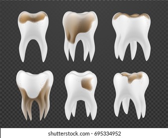 3d Tooth set, whitening design, realistic dental illustration. Teeth collection, vector template for dent surgery, clean, care, stomatology,...  Clean and dirty tooth, clearing process.