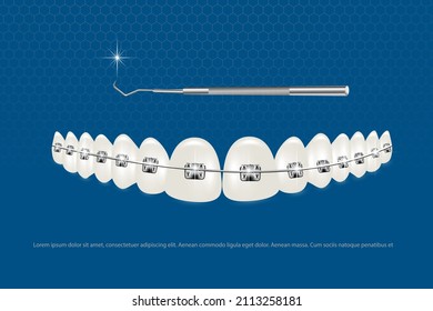 3d vector illustration, realistic teeth with braces. Alignment of the bite of teeth, dentition with braces, dental braces.