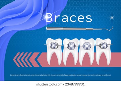 3d vector illustration, realistic teeth with braces upper and lower jaw. Alignment of the bite of teeth, dentition with braces, dental braces