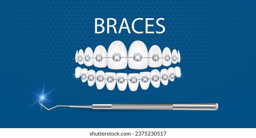 3d vector illustration, realistic teeth with braces. Alignment of the bite of teeth, dentition with braces, dental braces.