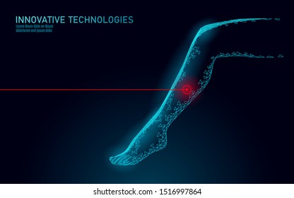 3D woman leg endovenous laser operation concept. Medical surgery veins varicose treatment female foot. Cosmetic hair laser depilation healthy massage salon care vector illustration