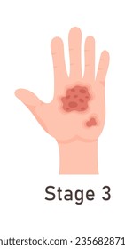 3rd Degree Of Skin Burn Vector Illustration