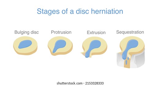 4 Stage of disc herniation. Medical diagram about spine problems that make back and neck pain.