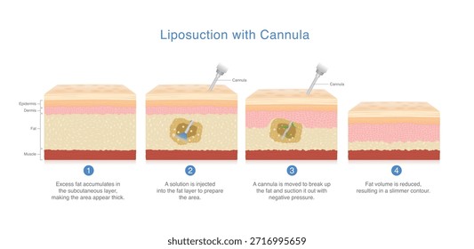 4 steps of Liposuction out of skin layer by Cannula. Excess fat reducing and make the skin layer thinner. Transformation under skin after beauty surgery.