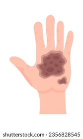 4th Degree Of Skin Burn Vector Illustration