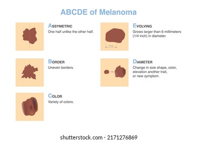 5 characteristics of skin damage of skin disease patient. Chart of ABCDE of melanoma (stands for asymmetry, border, color, diameter, and evolving)., For diagnosis and classification.