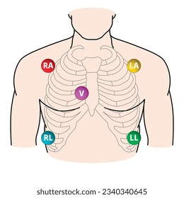 5 Lead Electrode Placement Electrocardiogram - RA, LA, RL, LL, V - Position of ECG 5 Leads - Vector Medical Illustration