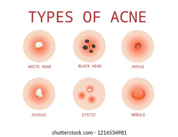 6 Types of Acne, Vector