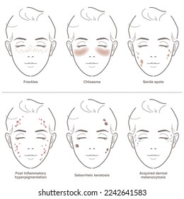 6 tipos de manchas faciales de edad.  Dibujo de la ilustración del vector.