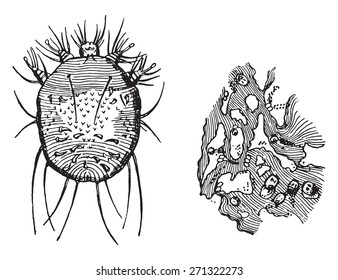 A-Acarus scabiei, B-Porción de epidermis, mostrando las madrigueras con sus huevos contenidos, ilustración vintage grabada. 