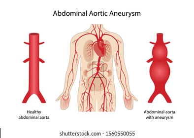 Abdominal aortic aneurysm. Arterial circulatory system of the abdominal. Healthy abdominal aorta and abdominal aorta with aneurysm. Vector illustration in flat style isolated on white background