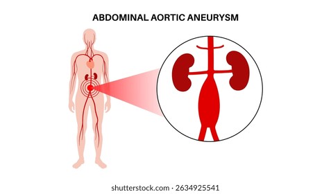 Aneurisma aórtico abdominal en el cuerpo humano. Presión arterial alta en la aorta abdominal. Inflamación en la sección abdominal. Diagrama médico, Ilustración vectorial de anatomía vascular humana