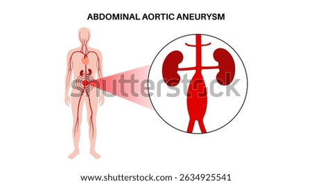 Abdominal aortic aneurysm in the human body infographic. High blood pressure in the abdominal aorta. Inflammation in the abdomen section. Medical diagram, human vascular anatomy vector illustration
