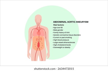 Pôster dos principais fatores de risco do aneurisma aórtico abdominal. Dor, hipertensão arterial ou inflamação na seção inferior próxima ao abdômen. Diagrama médico, anatomia vascular humana ilustração de vetor plano
