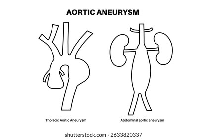 Aneurisma aórtico abdominal y aneurisma aórtico torácico. Presión arterial alta en el pecho y en la sección inferior cerca del abdomen. Diagrama médico, Ilustración vectorial plana de anatomía vascular humana