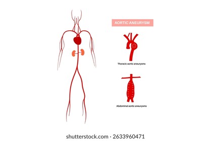 Aneurisma aórtico abdominal y aneurisma aórtico torácico. Presión arterial alta en el pecho y en la sección inferior cerca del abdomen. Diagrama médico, Ilustración vectorial plana de anatomía vascular humana