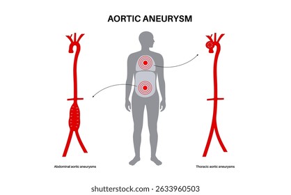 Aortenaneurysma abdominalis und Aortenaneurysma thoracicum. Hoher Blutdruck im Brustkorb und im unteren Bereich des Bauches. Medizinisches Diagramm, menschliche Gefäßanatomie, flache Vektorgrafik