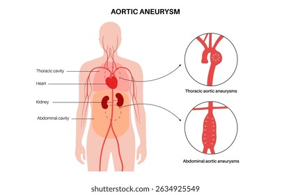 Aneurisma aórtico abdominal y aneurisma aórtico torácico. Presión arterial alta en el pecho y en la sección inferior cerca del abdomen. Diagrama médico, Ilustración vectorial plana de anatomía vascular humana