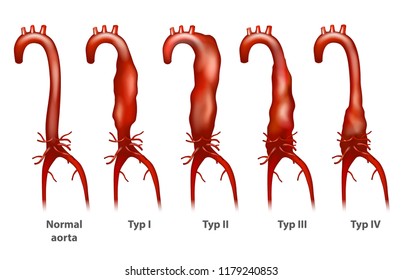 Abdominal Aortic Aneurysm Thoracoabdominal Crawford Classification ...