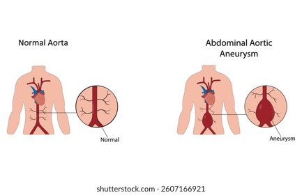 Abdominal aortic aneurysm vector illustration