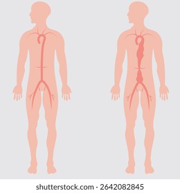 abdominal aortic aneurysm,heart aorta attack, aortic arch bulge open,vein clots stent stroke Marfan root left graft, hernia vessel pain High blood kidney damage Turner, stomach Pain