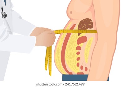  Abdominal fat surrounds the inner doors of the abdominal cavity. Overweight disease concept. Weight loss, liposuction, and diet.