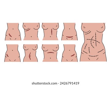 Abdominal incisions line icons set. Vector isolated element. Editable stroke.