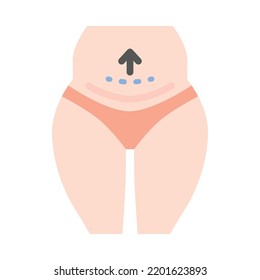 Diseño plano de liposucción abdominal. Cirugía estética en el cuerpo femenino con líneas punteadas. Para clínicas de cirugía plástica, publicaciones médicas y de belleza. Ilustración vectorial.