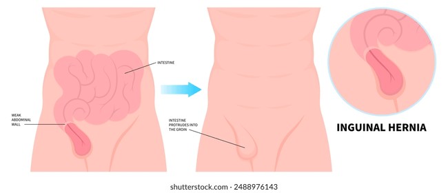 abdominal pain belly button of inguinal incisional Femoral stomach diastasis recti small large ileus lump navel wall cavity baby infant birth umbilical hernia volvulus constipation intestine Hiatus