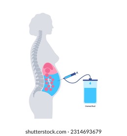 Procedimiento de paracentesis abdominal. Fluido en el abdomen. Drenar líquido asítico para diagnóstico o tratamiento. Se introduce una aguja o catéter en la cavidad peritoneal. Eliminar el exceso de líquido del vector del vientre