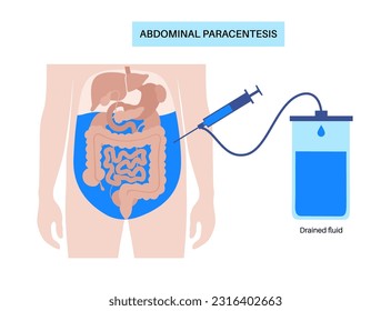 Abdominal paracentesis procedure. Fluid in abdomen. Drain ascitic fluid for diagnostic or therapy. A needle or catheter is inserted into the peritoneal cavity. Remove excess fluid from belly vector