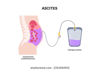 Abdominal paracentesis procedure. Fluid in abdomen. Drain ascitic fluid for diagnostic or therapy. A needle or catheter is inserted into the peritoneal cavity. Remove excess fluid from belly vector